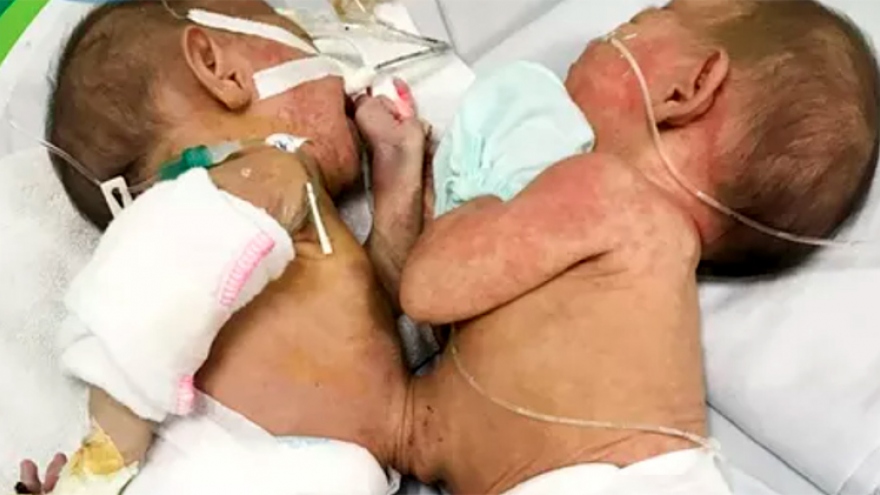 Conjoined twins to undergo separation surgery